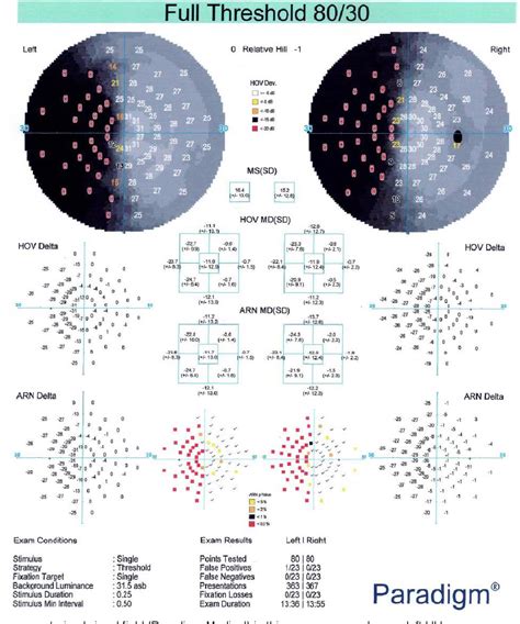 Figure 1 from Rehabilitation of Left Homonymous Hemianopia with Adjacent Palomar Prism Technique ...