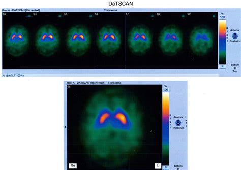 Image result for Normal DaTscan