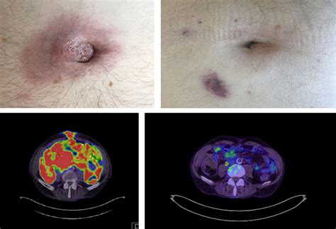 Sister Mary Joseph Nodule