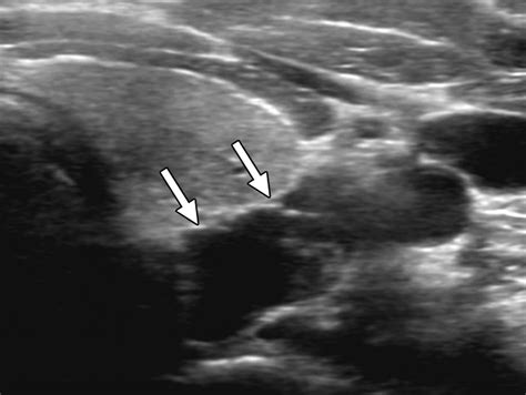 Adenoma De Paratireoide Giant Parathyroid Adenoma Associated With