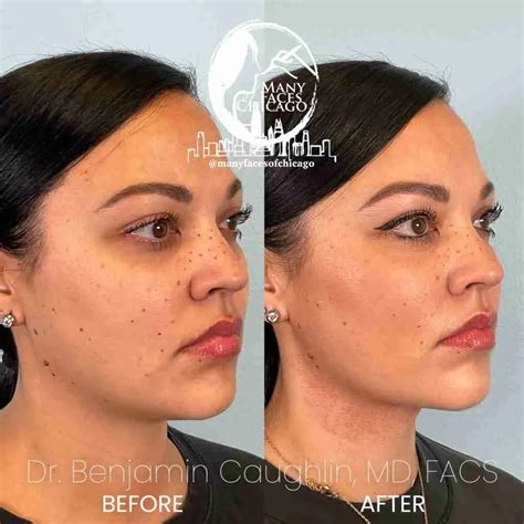 FaceBBL | Fat Transfer Treatment To Sculpt Your Face and Jawline