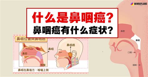 【Sick 問識答】早期鼻咽癌病徵難察覺 身體出現5大警號要小心 - 晴報 - 健康 - 腫瘤及癌症 - D200312