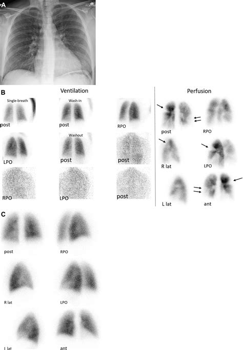 Ventilation-Perfusion Scan: A Primer for Practicing RadiologistsRadioGraphics