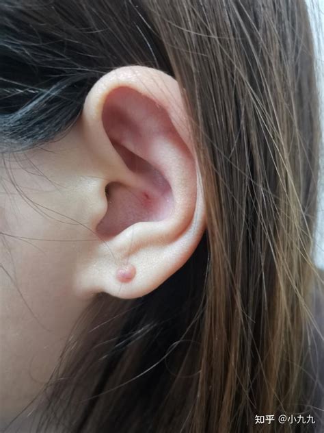 打耳洞形成的瘢痕疙瘩治疗分享 - 知乎