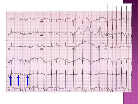 ECG: Multifocal Atrial Tachycardia | PPT