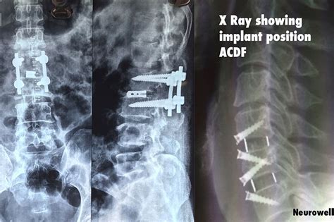 Image result for Spinal Fixation