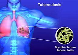 tuberculosis 的图像结果