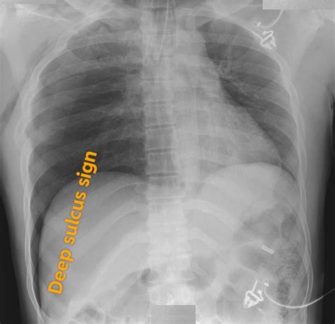 Deep sulcus sign of pneumothorax. https://youtu.be/fk964fQBYqY : r/FOAMed911