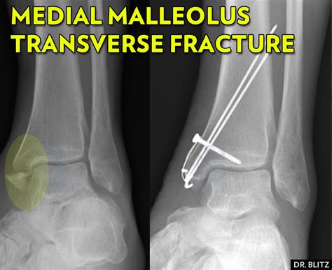 5 types de fractures de la malléole médiale de la cheville