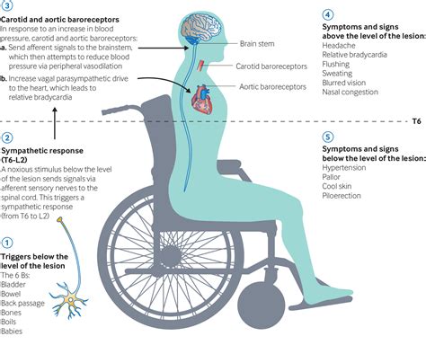 Spinal Cord Injury Blood Pressure at Vanessa Rutland blog