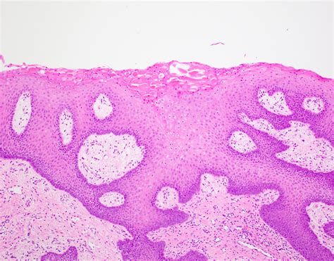 Pathology Outlines - Proliferative verrucous leukoplakia (PVL)