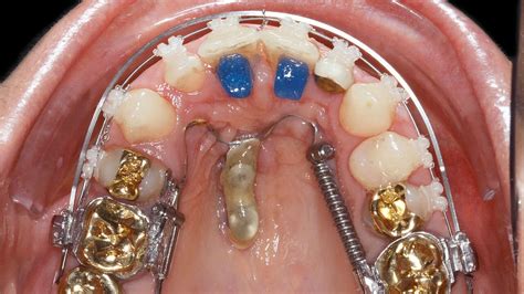 Die Motivation erwachsener Patienten zur kieferorthopädischen Therapie ...