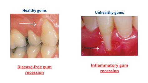 Receding Gums vs Healthy Gums: See the Differences with Images