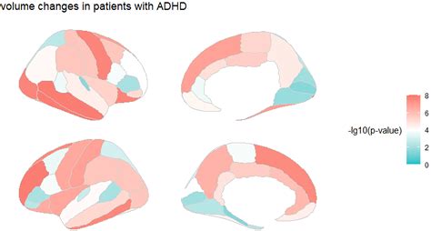 Brain Markers of ADHD Identified in Children’s MRI Scans