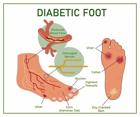 Arterial Ulcer On Foot Online | emergencydentistry.com