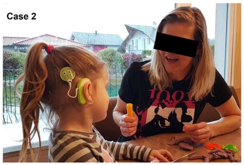 Systematic Literature Review and Early Benefit of Cochlear Implantation ...