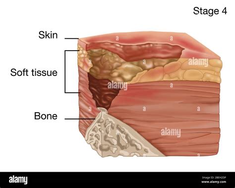 Stage 4 of a Bedsore, Illustration Stock Photo - Alamy