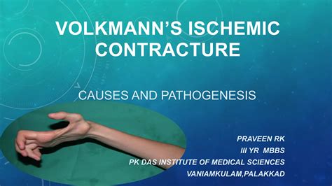 Volkmann contracture | PDF