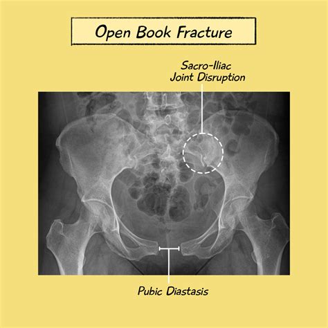 Pelvic Fracture: In-Depth Overview for Students (With PPT)