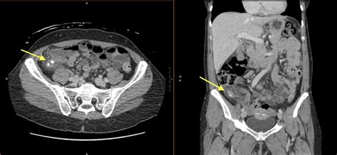 Appendicitis On Ct