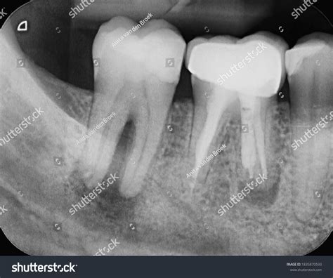 Root Canal Infection Xray