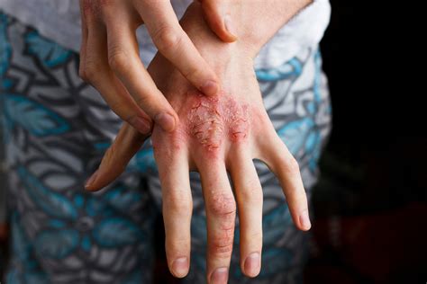 Natural Ways to Deal With Eczema On Hands - Dr. Ana-Maria Temple