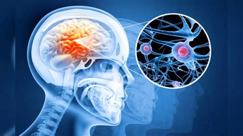 Rugby Player Posthumously Diagnosed With Brain Disease Caused By ...