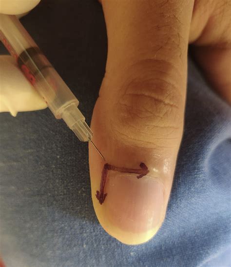 Can Nail Psoriasis Be Cured? 4 Best Nail Psoriasis Treatment Options - Be Your Best, Well, Self