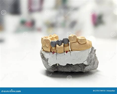 Metal Caps for the Manufacture of Dental Ceramic-metal Dental Bridges Stock Photo - Image of ...