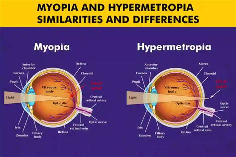 Image result for Myopia Hyperopia