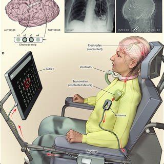 Als Expensive Brain Computer Interface 的图像结果