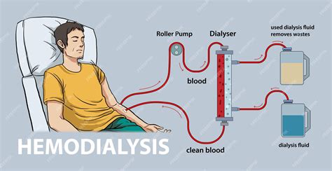 Premium Vector | Illustration of hemodialysis diagram