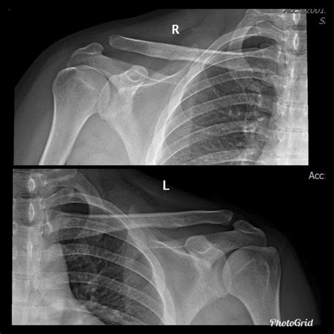 Acromioclavicular Joint Dislocation X Ray The Shoulder