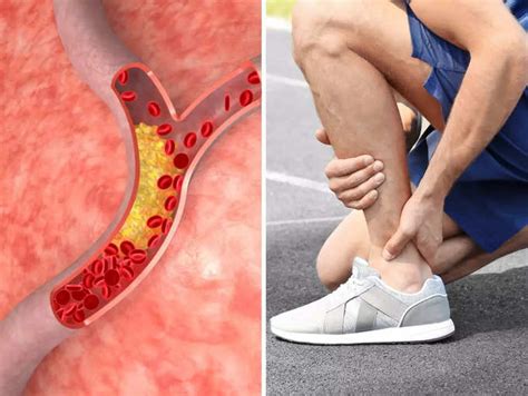 High Cholesterol Symptoms: Note this warning sign in the leg while ...