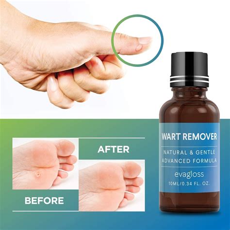 Evagloss Natural Wart Remover - Maximum Strength Liquid Gel for Plantar, Common & Genital Warts ...