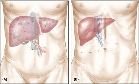Laparoscopic-assisted liver transplantation: A realistic perspective ...
