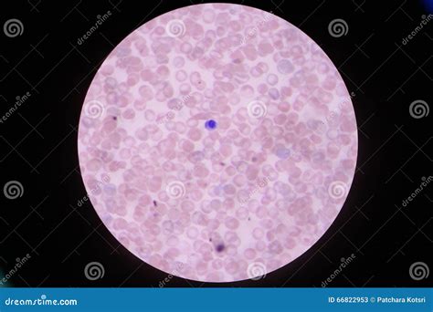 Nucleated Red Blood Cells NRC In Blood Smear Stock Photo ...