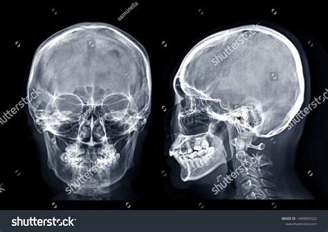 Skull X Ray Anatomy