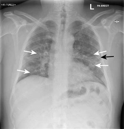 Staph pneumonia chest x ray findings - smtaste