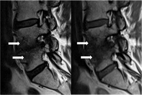 Vertebral bone marrow (Modic) changes - Clinical Tree