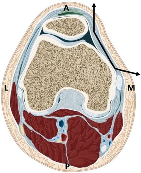 A Simple Technique for Reconstruction of the Medial Patellofemoral Ligament With Patellar Soft ...