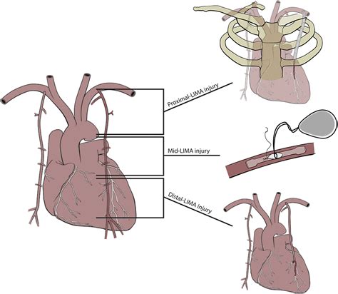 Bailouts to LIMA Damage for Avoiding Conversion in Minimal Access Coronary Procedures - The ...