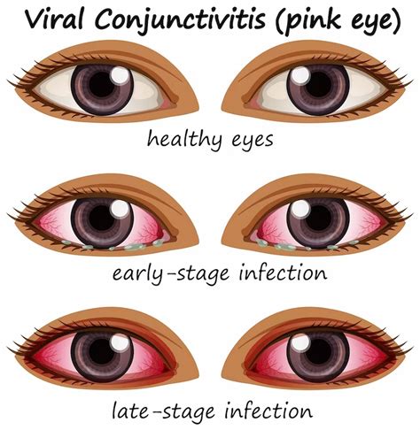 Viral or Bacterial Conjunctivitis: Which one is worse?