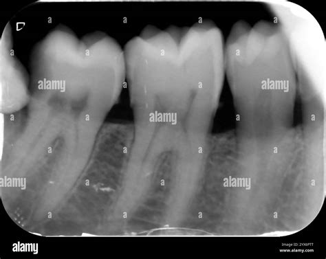 Periapical X-ray of a healthy right lower premolar and the first and ...