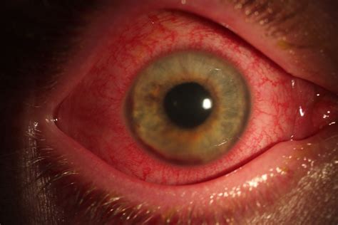 50 Facts About Uveitis - Facts.net