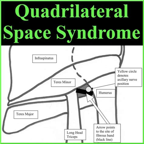 Quadrilateral Space Quadrilateral Space Syndrome: Causes, Symptoms,
