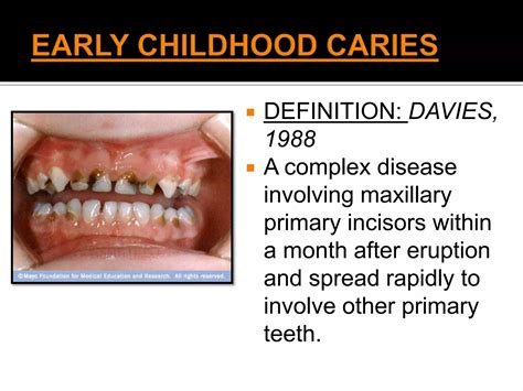 Early childhood caries | PPTX
