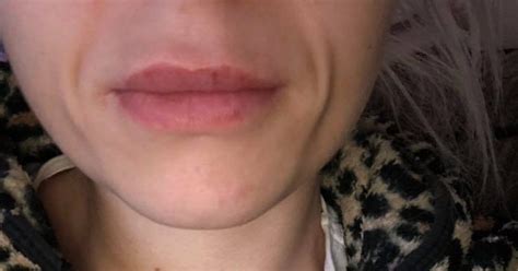 Signs Of Bad Lip Filler at Grace Makin blog