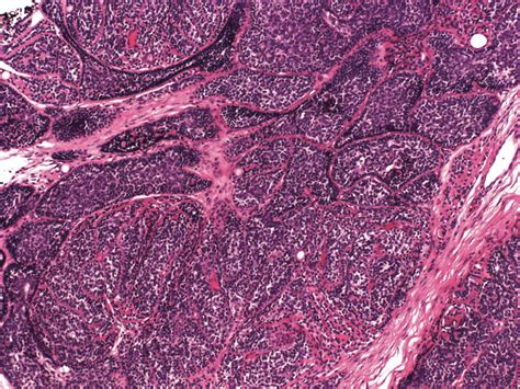 brooke spiegler syndrome gene – brooke spiegler syndrome treatment – XGGM