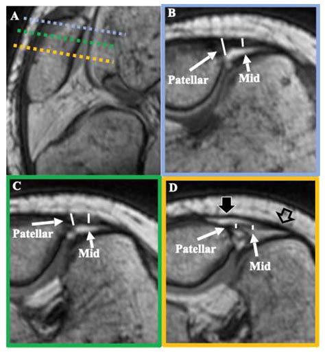 Surgical and Radiological Anatomy of the Medial Patellofemoral Ligament ...